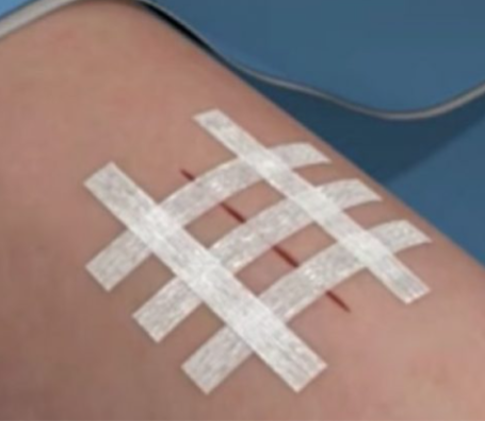 Steri-Strip Application / 免缝胶带使用示例